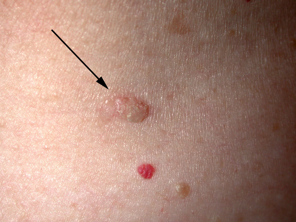 seborrheic keratosis