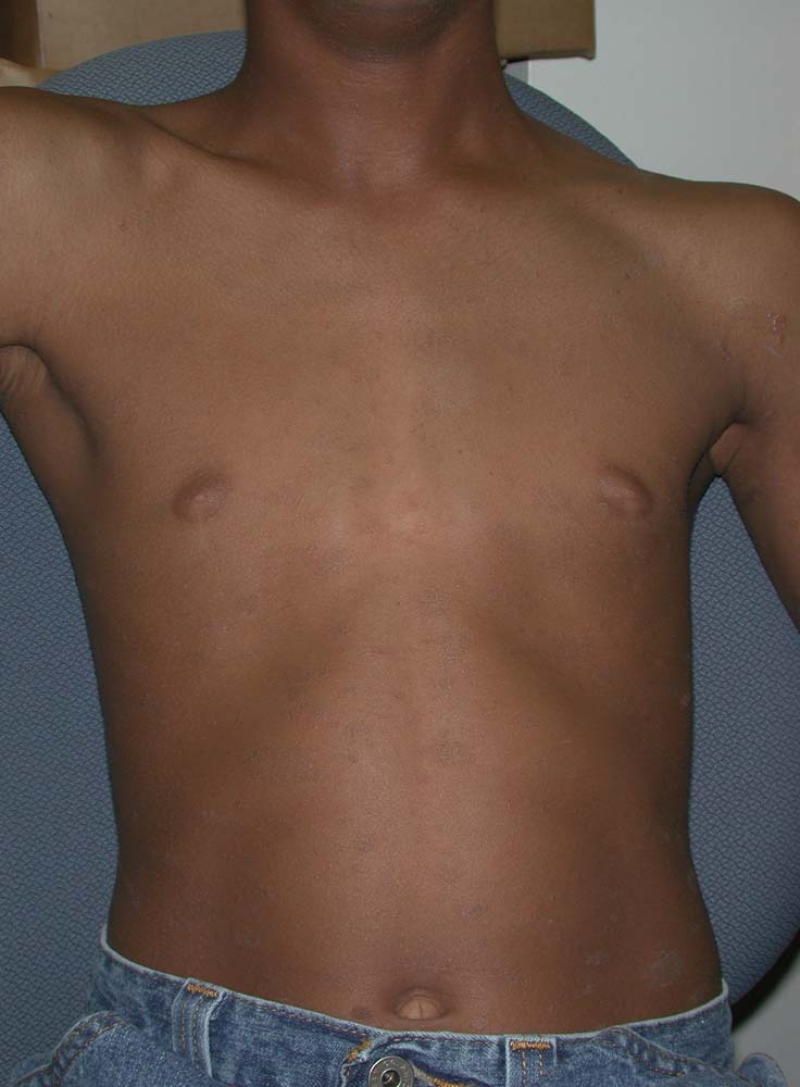 pityriasis rosea