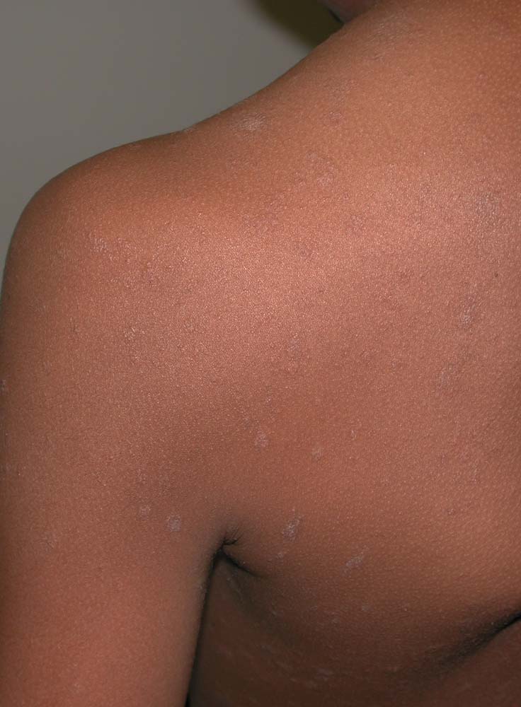 pityriasis rosea