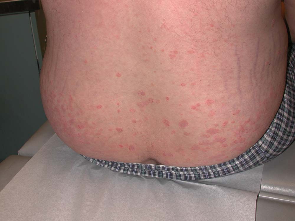 psoriasis