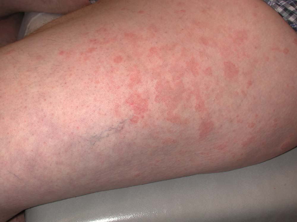 psoriasis