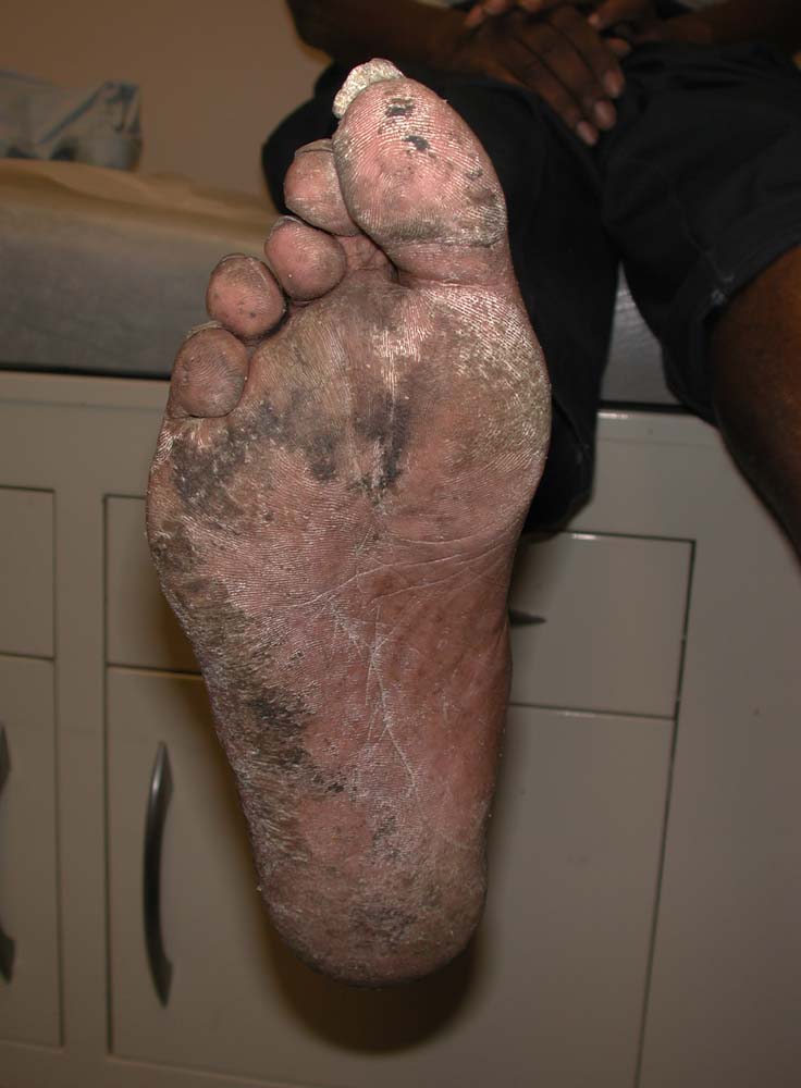 tinea pedis