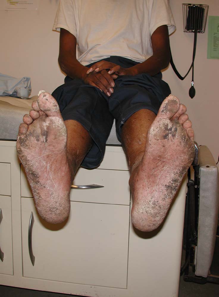 tinea pedis