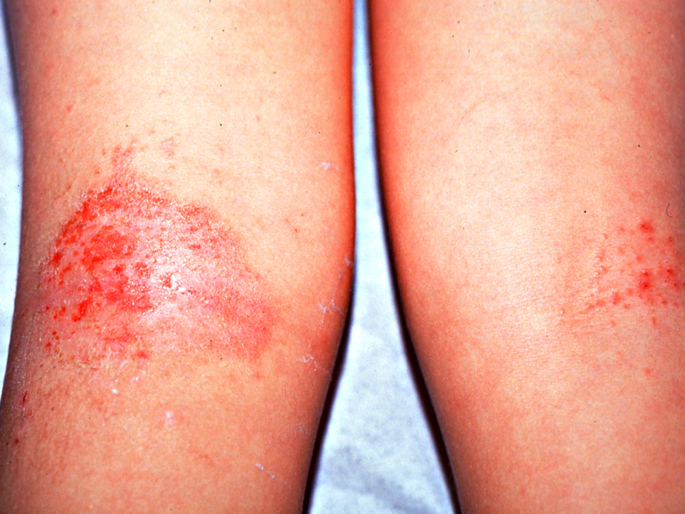 atopic dermatitis