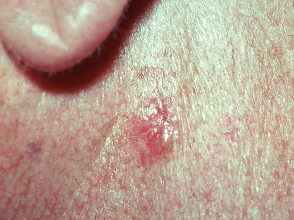 basal cell carcinoma, nodular