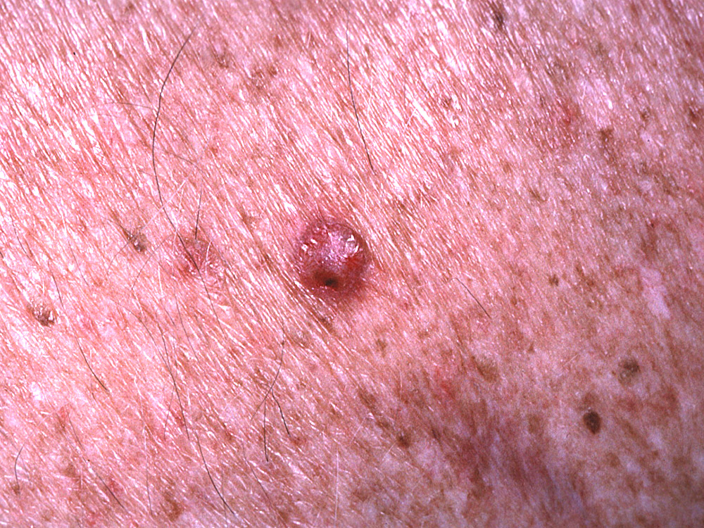 basal cell carcinoma, nodular