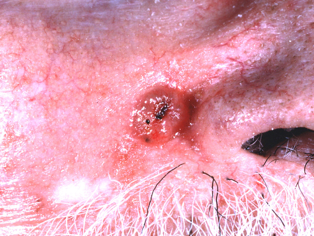 basal cell carcinoma, nodular