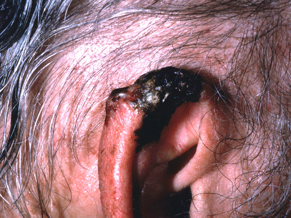 basal cell carcinoma, nodular