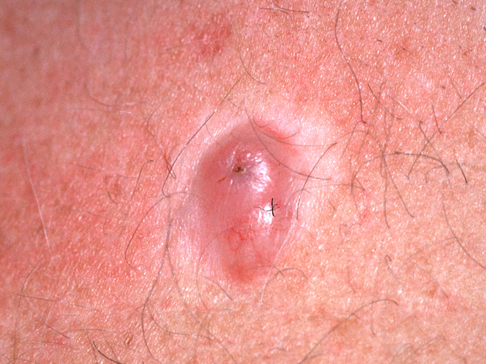 basal cell carcinoma, nodular