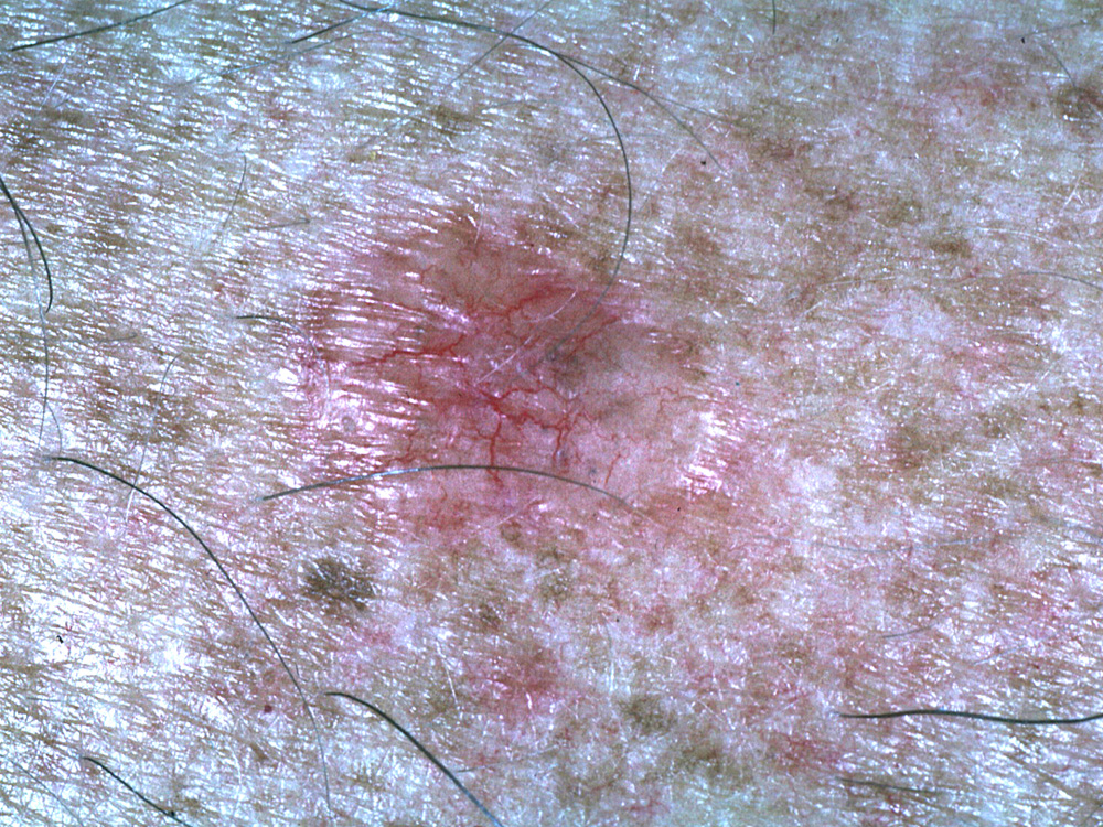 basal cell carcinoma, nodular