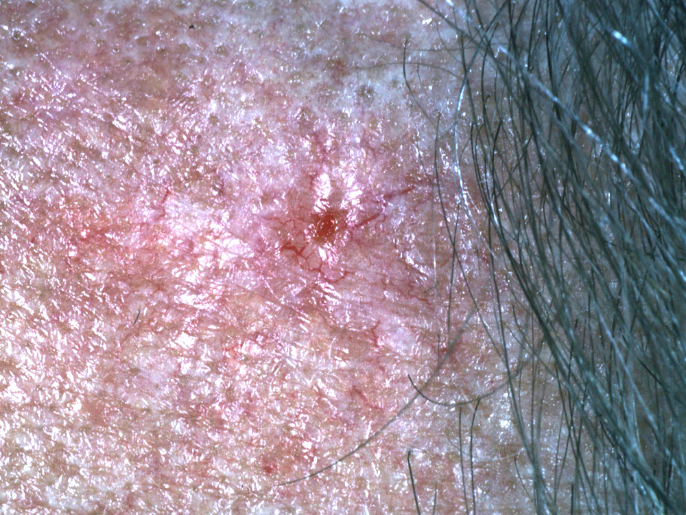 basal cell carcinoma, nodular
