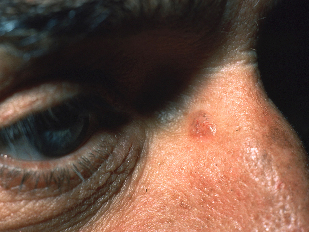 basal cell carcinoma, nodular