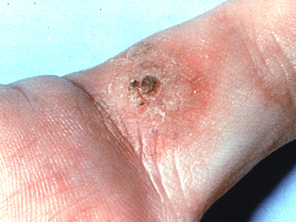Bowen's disease