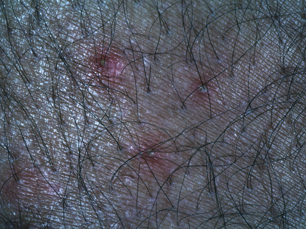 folliculitis