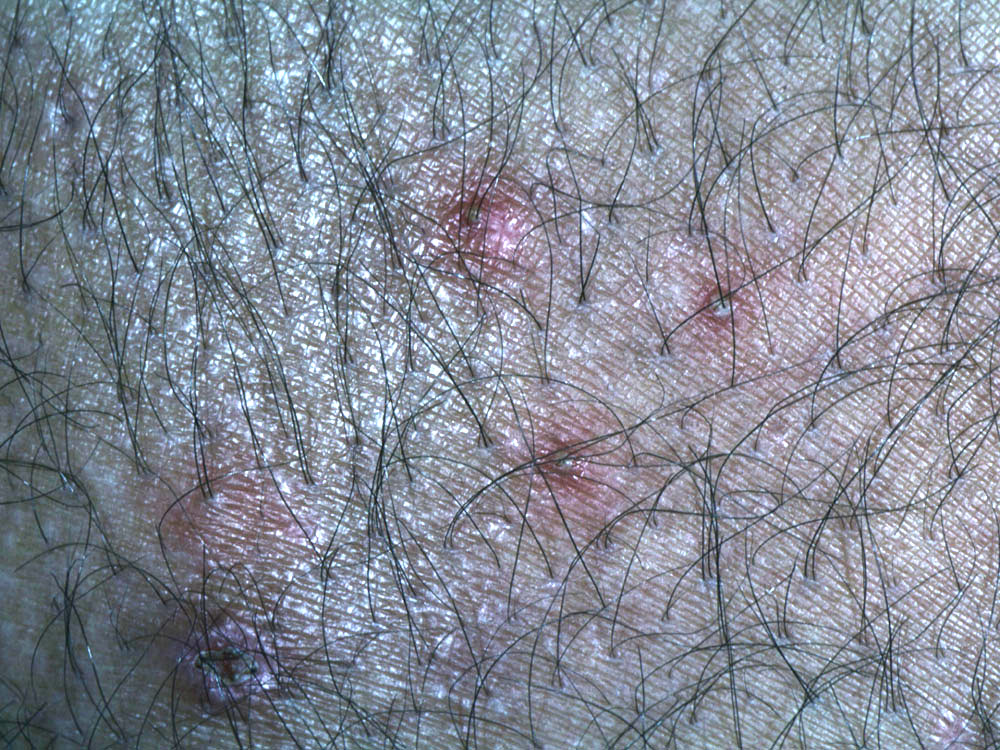 folliculitis