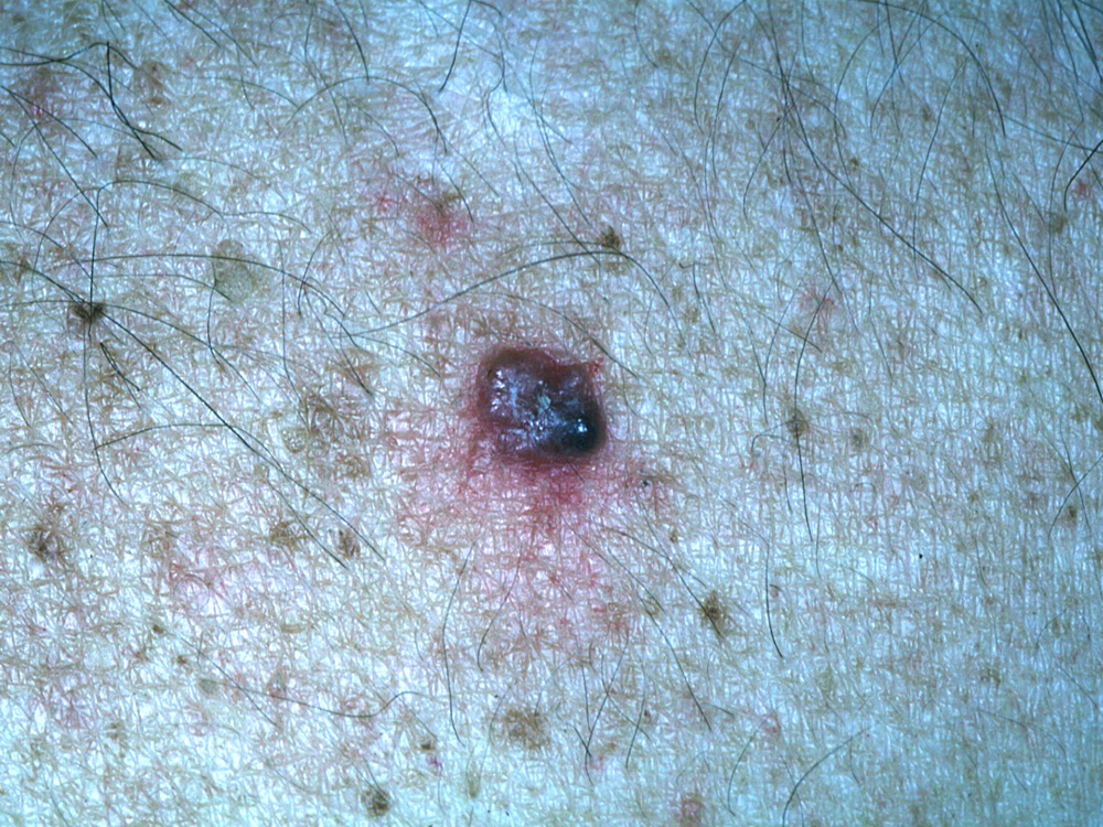 basal cell carcinoma, nodular