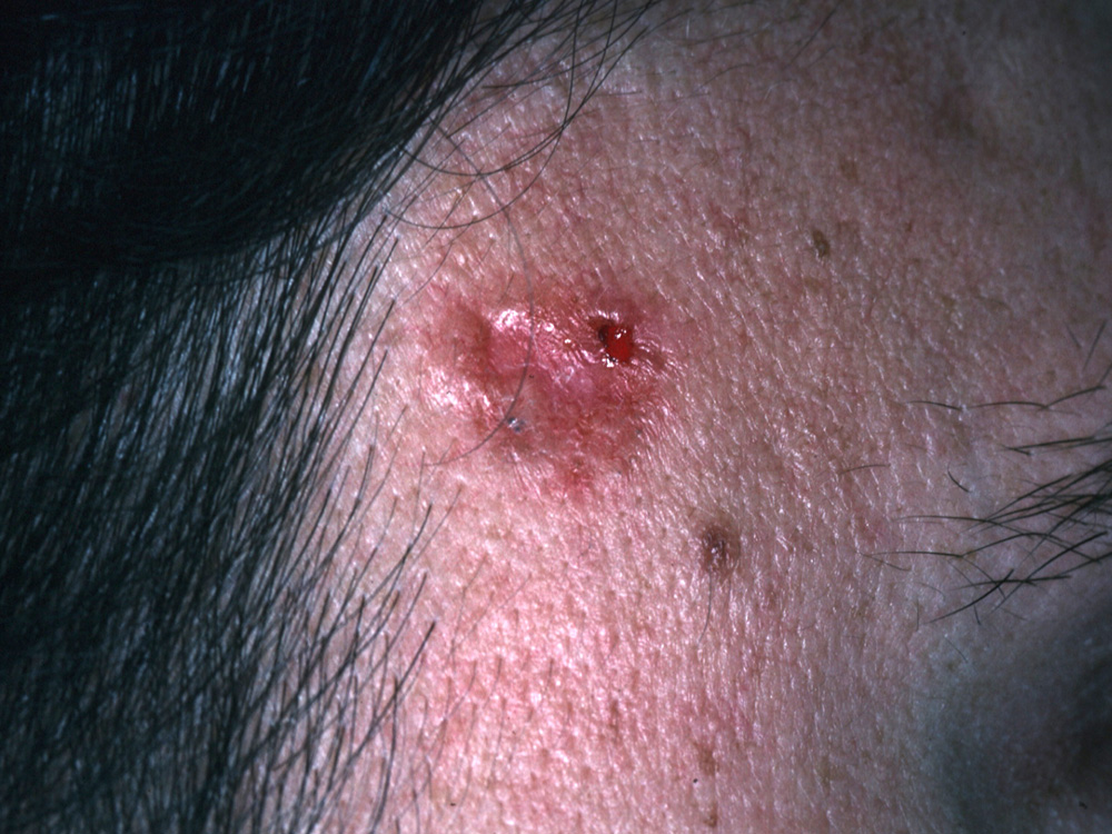 basal cell carcinoma, nodular
