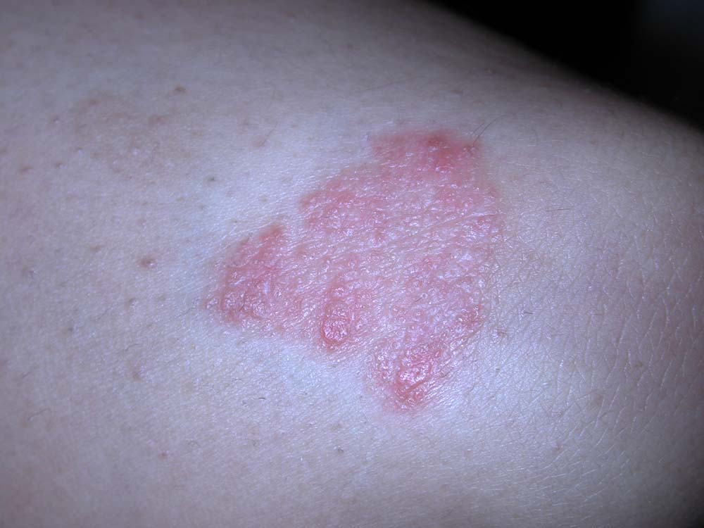 psoriasis