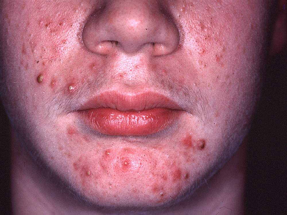 acne