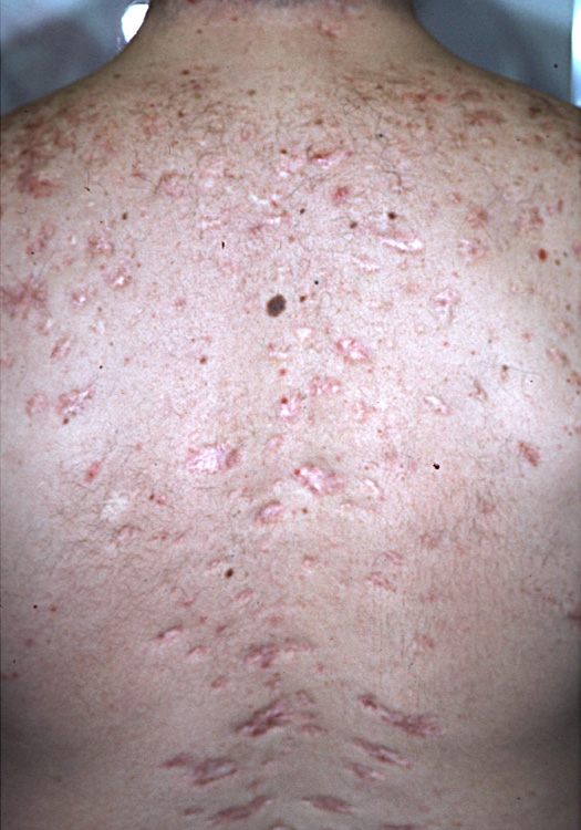 acne keloidalis scars 