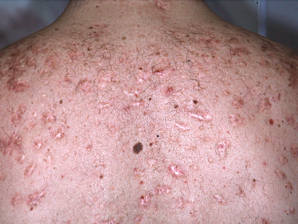 acne keloidalis scars 