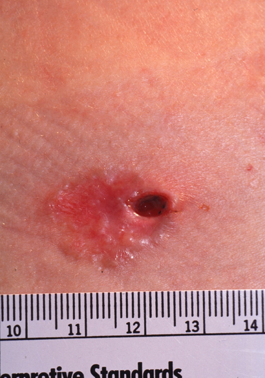 basal cell carcinoma, nodular