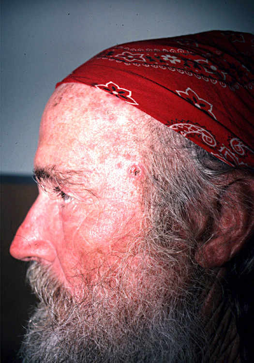 basal cell carcinoma, nodular