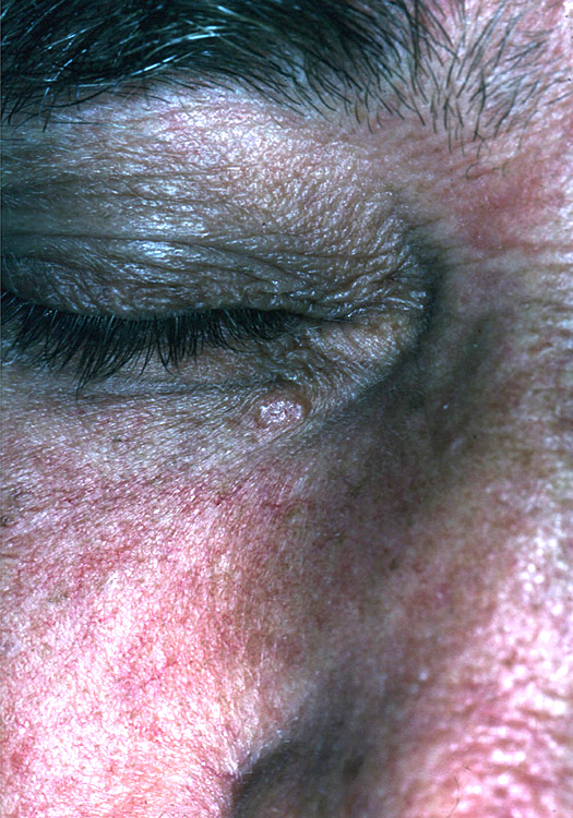 basal cell carcinoma, nodular