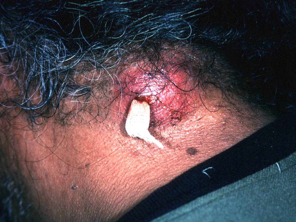 cyst, epidermal