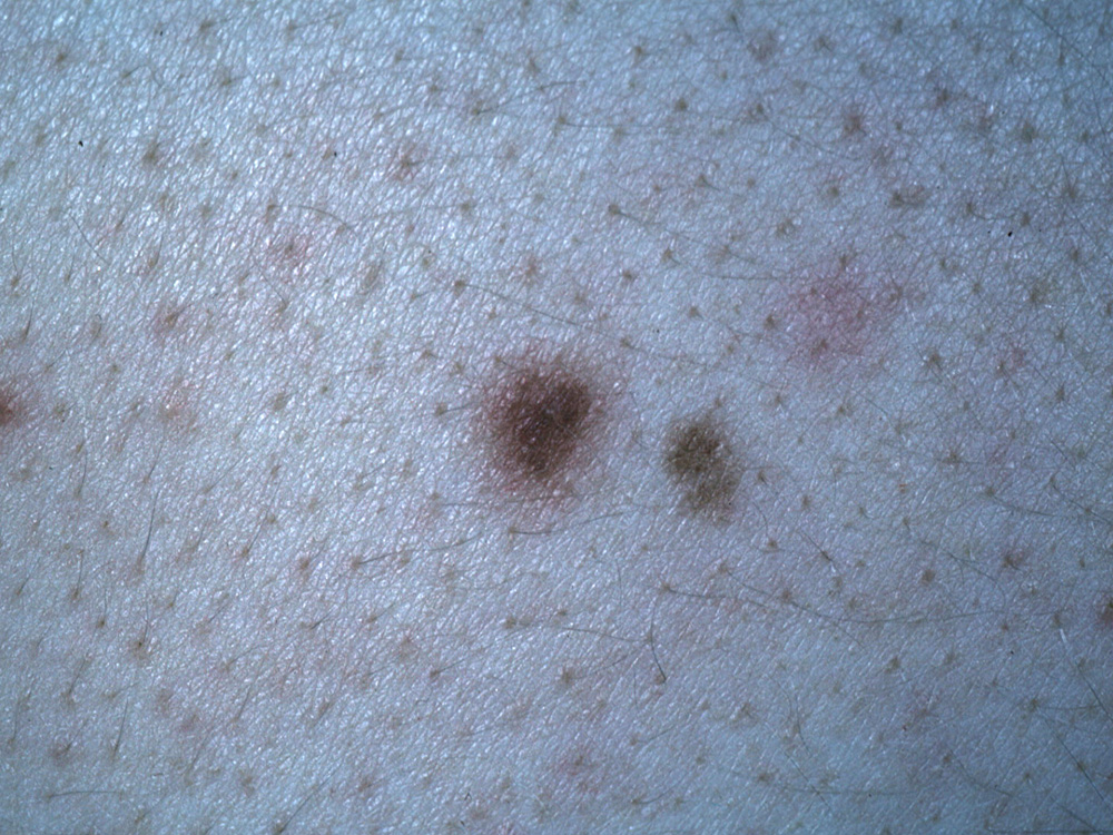 nevus, dysplastic