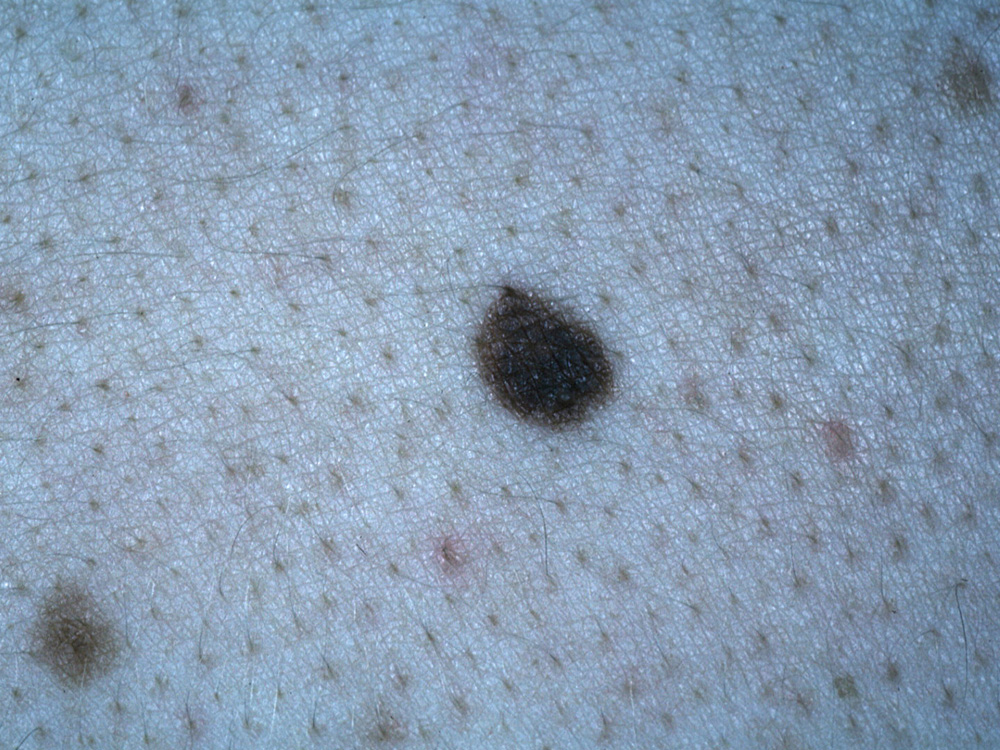 nevus, dysplastic