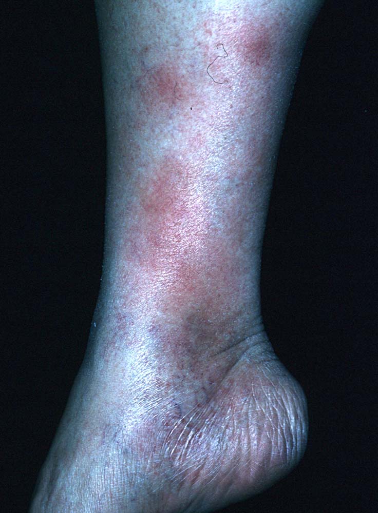 erythema nodosum