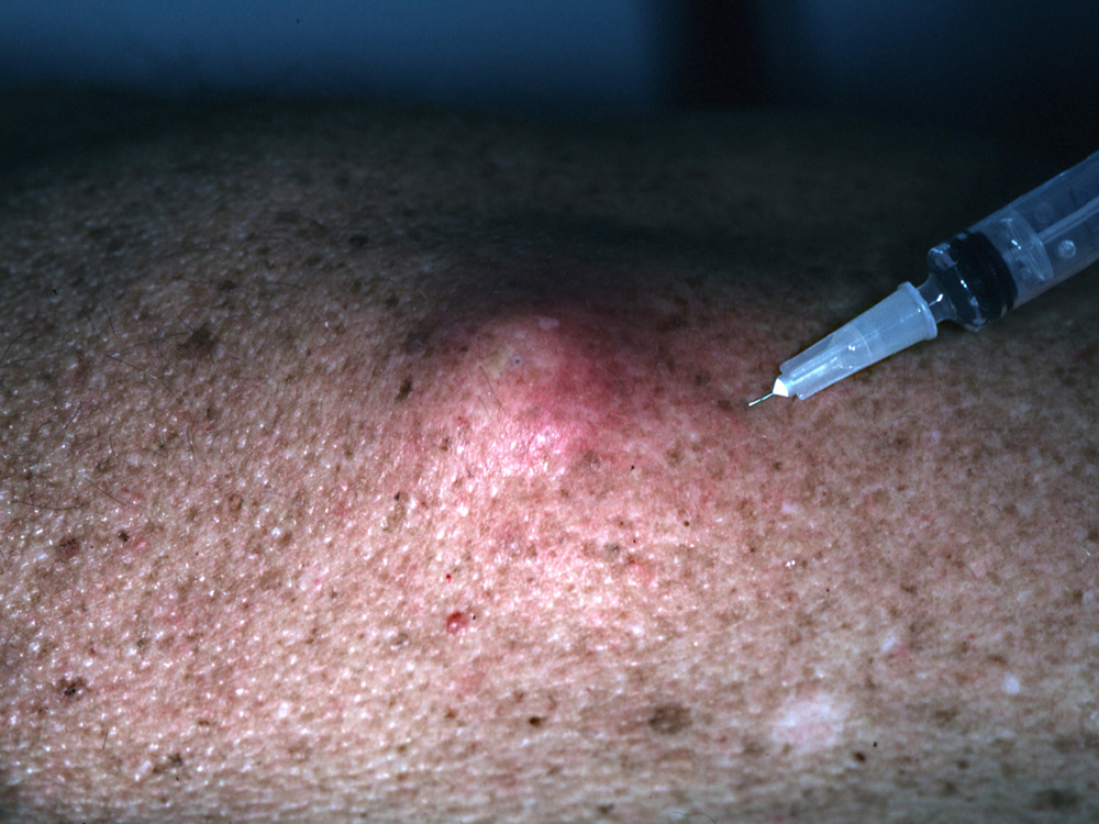 cyst, epidermal