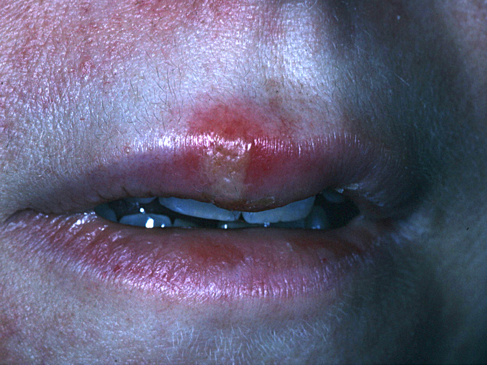 herpes simplex type I