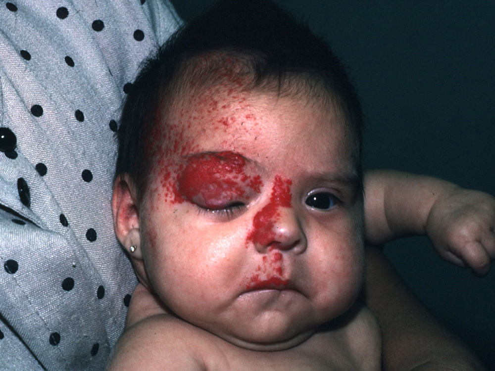 hemangioma, strawberry