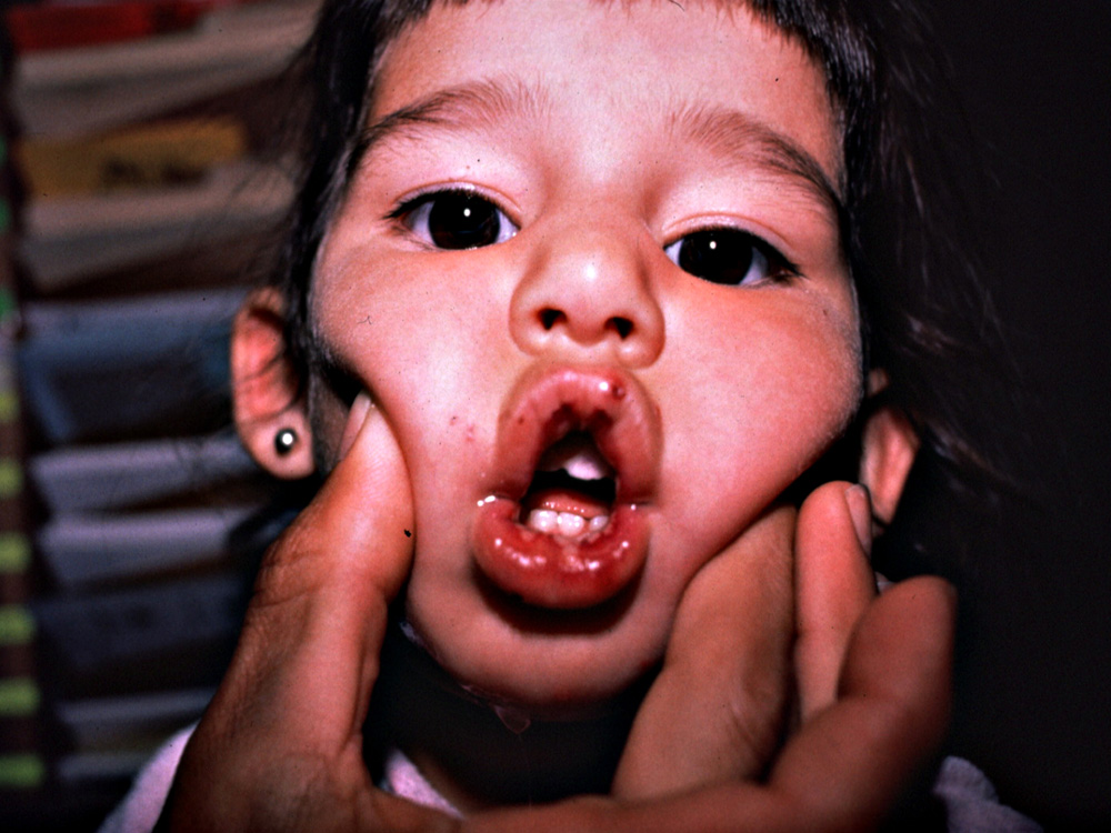 herpes simplex type I