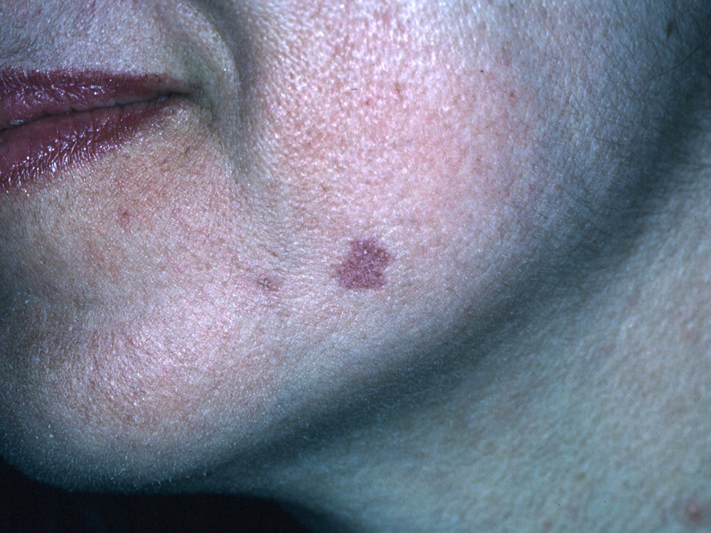 hemangioma, strawberry