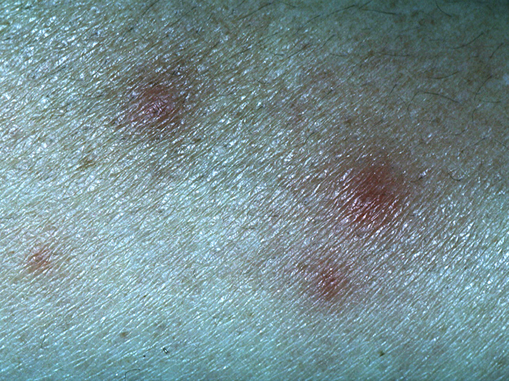 folliculitis