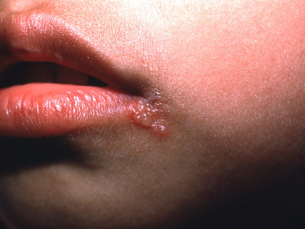 herpes simplex type I
