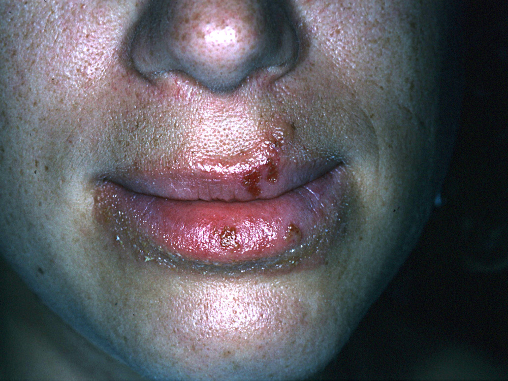 herpes simplex type I