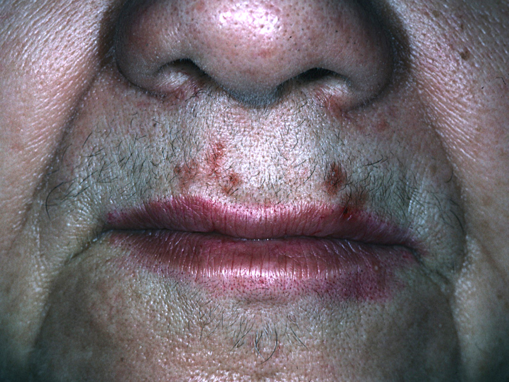 herpes simplex type I