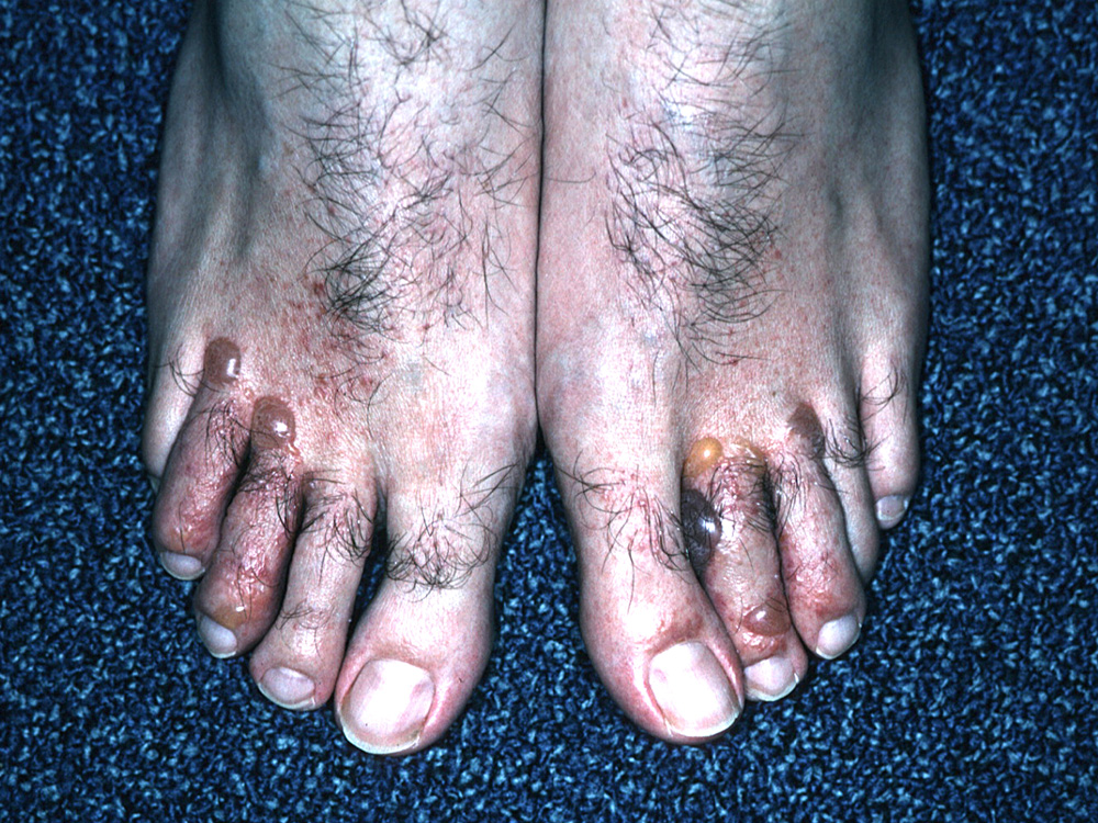 tinea pedis