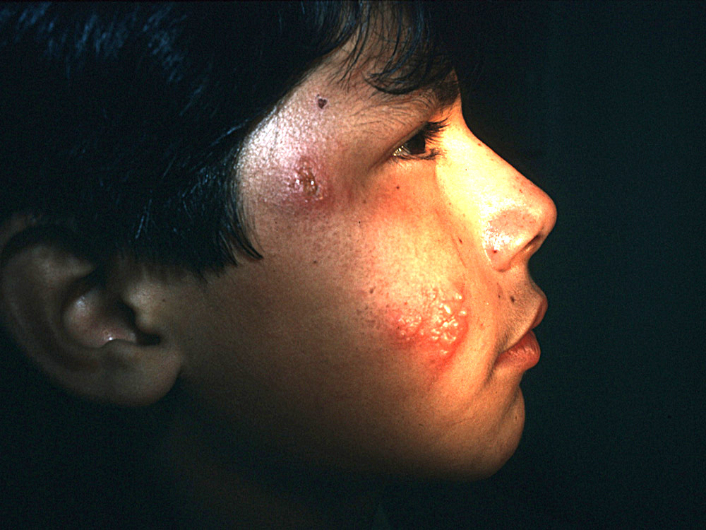 impetigo