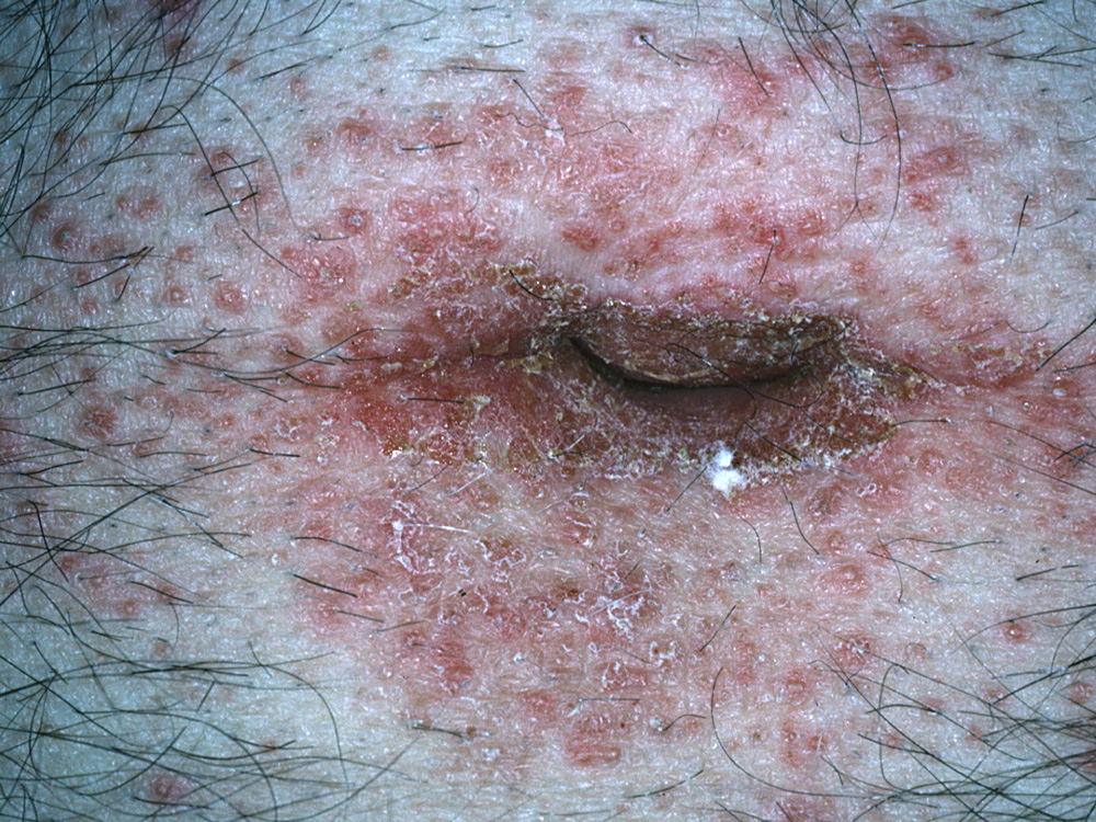 impetigo