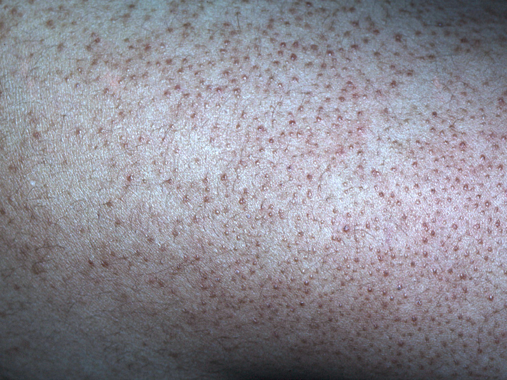 keratosis pilaris