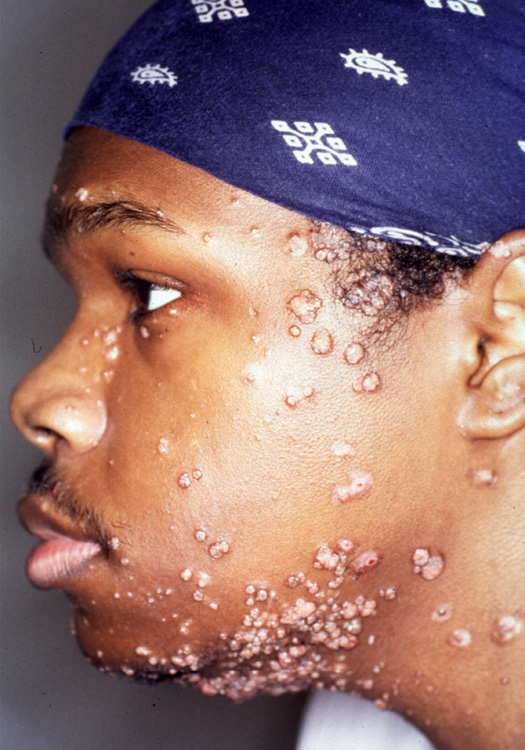 molluscum contagiosum