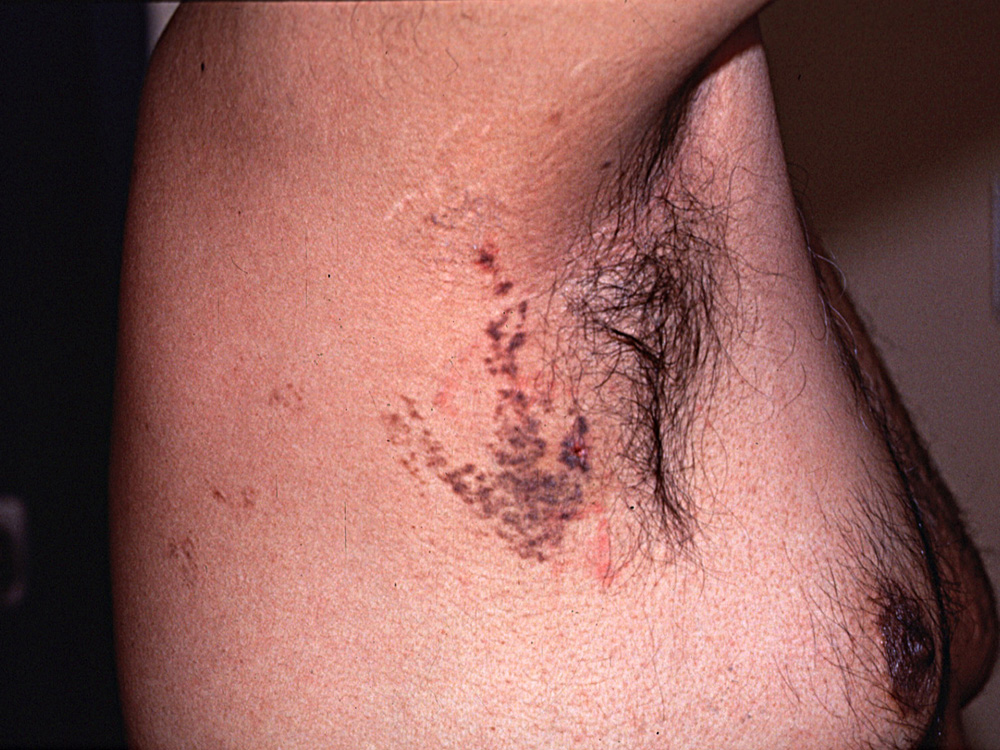 melanoma, superficial spreading