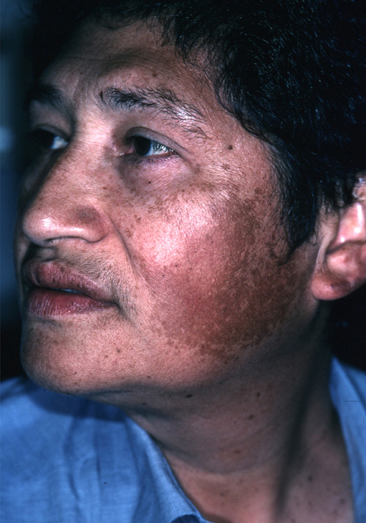 melasma