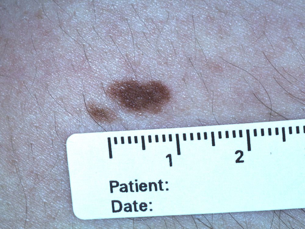 nevus, congenital