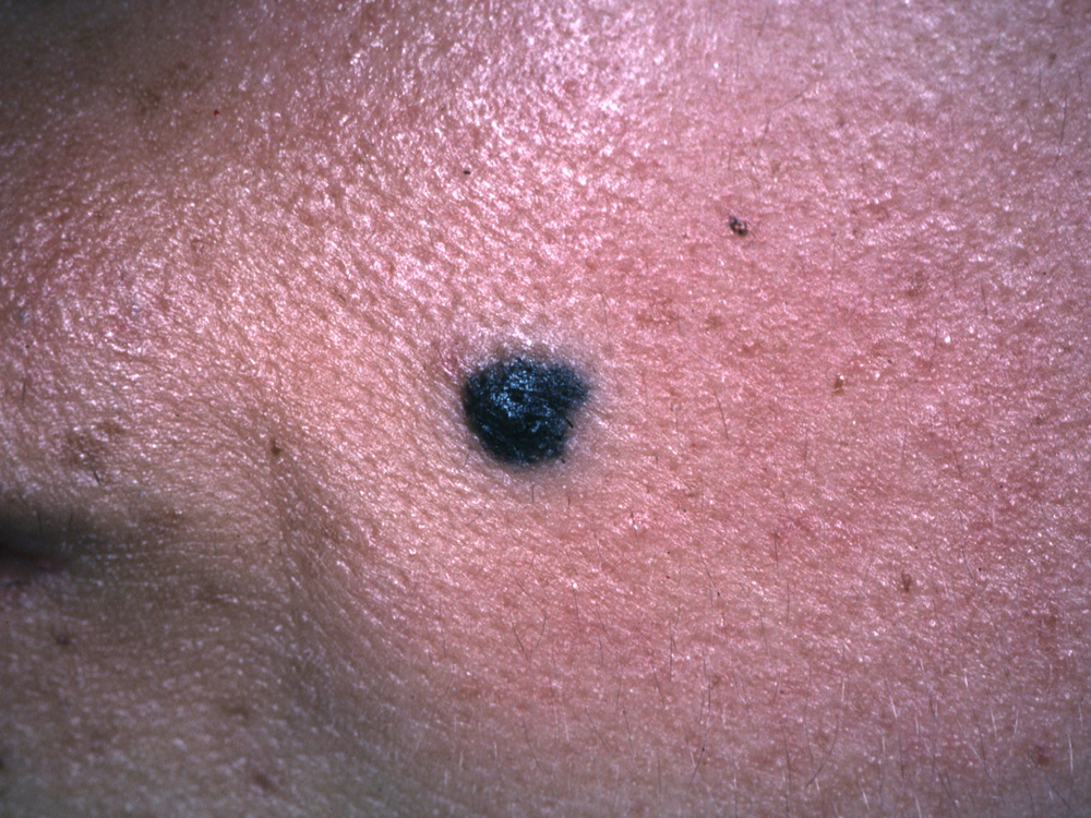 nevus, blue